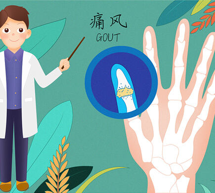 图腾益生风之友浅谈痛风的征兆有哪些？