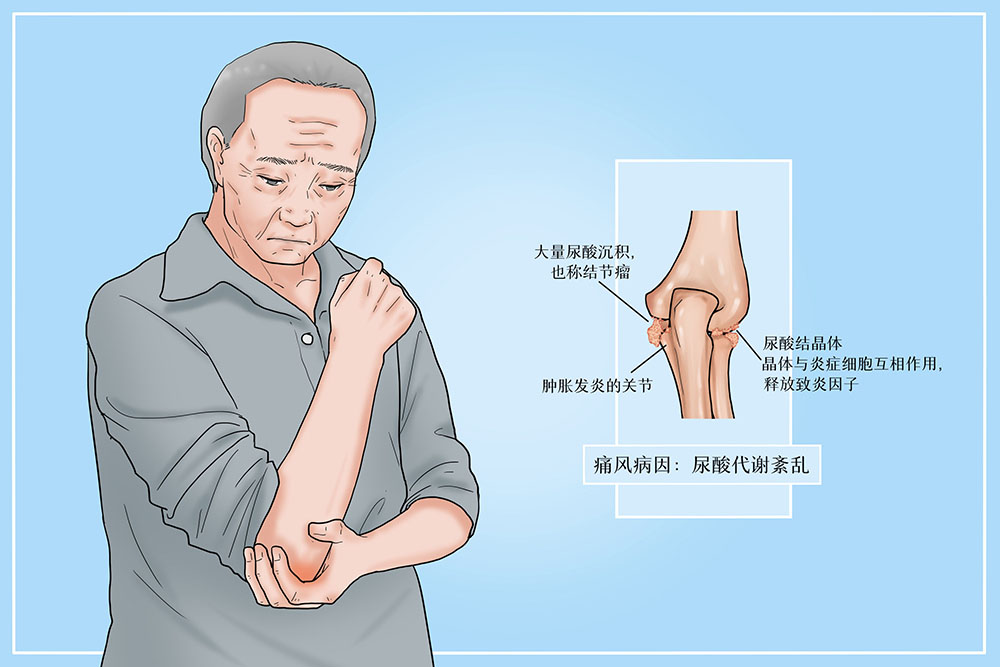 高尿酸是如何引起的？有哪些治疗方法？风之友为您答疑